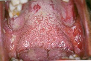 Opportunistic Infection by Candida albicans in an AIDS Patient Source: Atlas of Clinical Oral Pathology, 1999 Candidiasis of