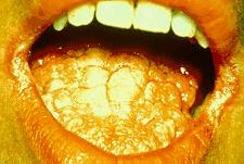 Candidiasis of skin, mucous membranes and nails Oropharyngeal candidiasis, including: THRUSH