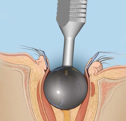 Evaluation and Planning Successful implantations are technique sensitive and require careful preoperative planning.