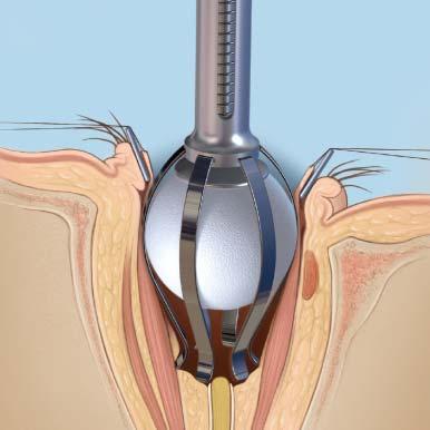 Surgical Technique 2 Implantation continued To insert the implant into the orbit: