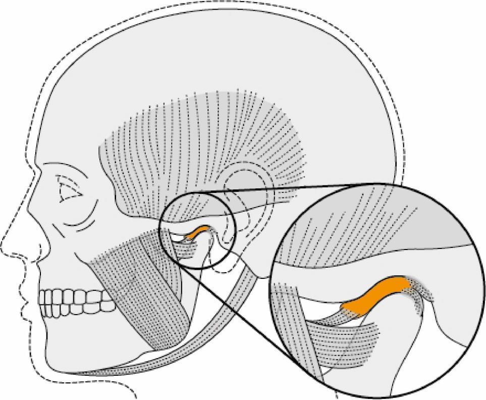 Disc Diagram of temporomandibular joint What is Temporomandibular Disorder (TMD)? TMD is a common, painful condition which frequently gets better on its own.