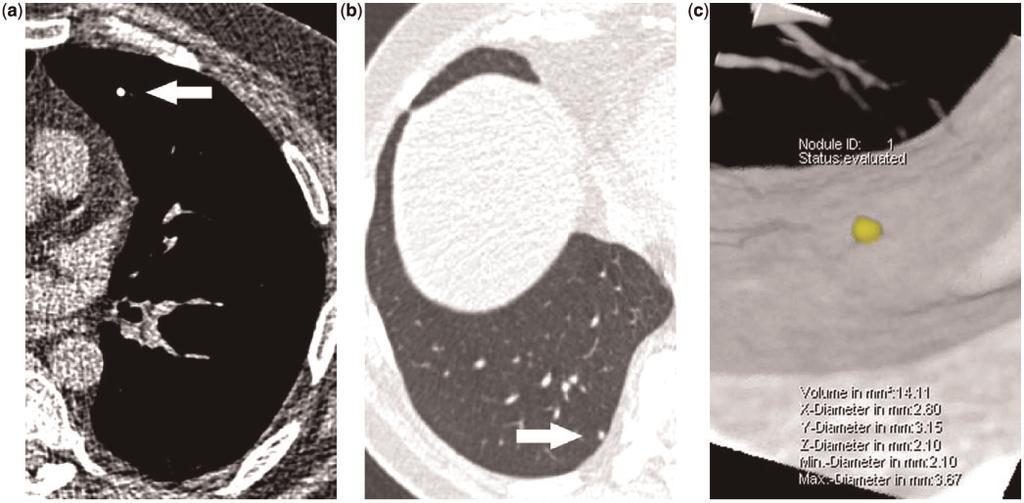 392 X. Xie et al. Figure 1 A complete calcified nodule is considered as benign on a transverse thin-slice CT image in the soft tissue setting (a).