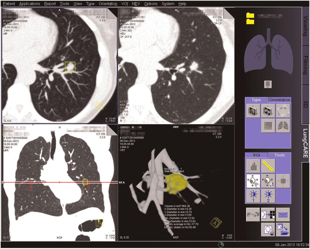 Radiological evaluation of lung cancer screening CT 393 Figure 2 Screen capture of dedicated software to semi-automatically measure the volume of a solid nodule (LungCare, Siemens, Forchheim,