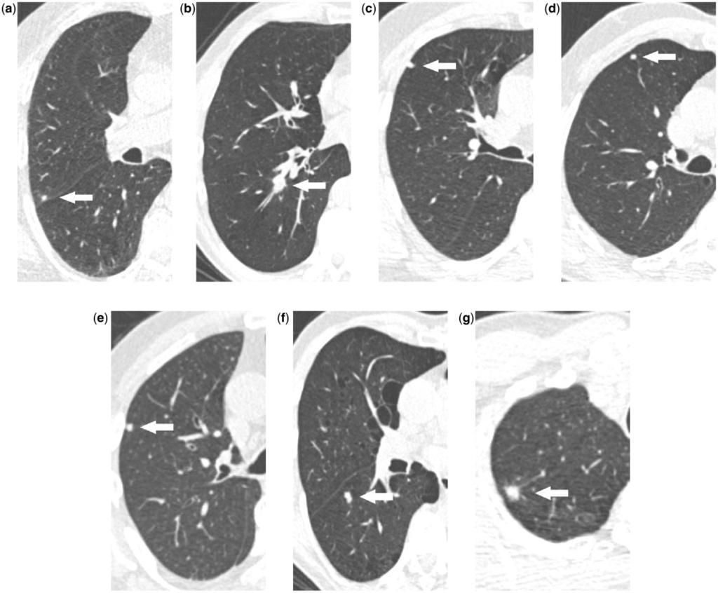 394 X. Xie et al. Figure 4 Example images of four nodule attachment types: peri-fissural (a), vessel-attached (b), pleural-based (c) and intraparenchymal (d).