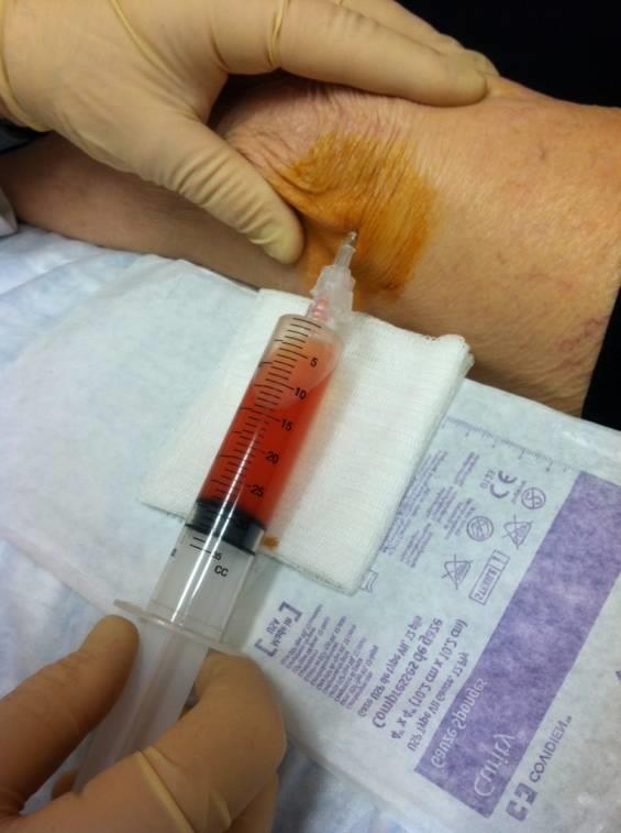 Knee Aspiration & Injection Change syringe at hub sterile Inject Cortisone solution 3ml Bupivacaine 0.