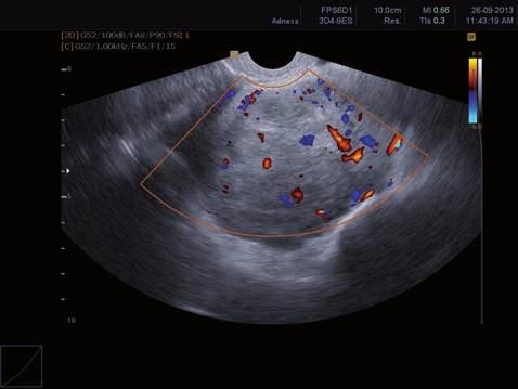 3 mm Septae No Thin < 3 mm ------------ Thick 3 mm Doppler features Vessel location Peri-tumour Peripheral Central or septal Colour score 1 2 3 4 A score 6 was considered as suspicious of malignancy.