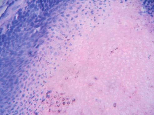 Original Article A-238 One case of adenoid cystic carcinoma encountered in the present study presented as a cyst involving the scalp in an elderly male.
