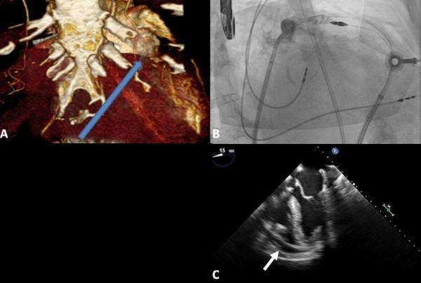Hussain A et al, Hemostasis of Left Atrial Appendage Bleed With Lariat Device 274 A Tuohy needle was used to enter the pericardial space via a subxiphoid approach under fluoroscopic guidance.