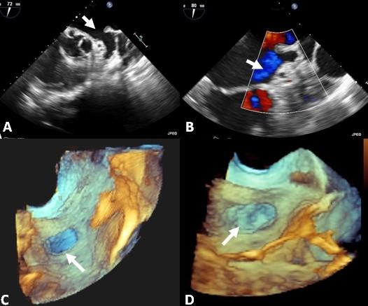 Hussain A et al, Hemostasis of Left Atrial Appendage Bleed With Lariat Device 275 directed more laterally from the first.