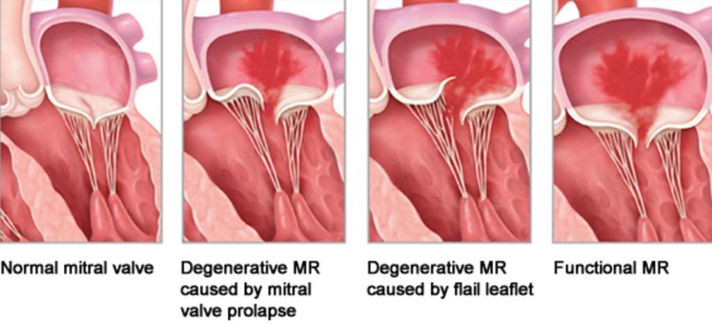 Mitral regurgitation and Mitraclip Degenerative MR: Mitral valve prolapse or flail leaflet Candidates: Significant degenerative MR 3+, symptomatic (exertional dyspnea),