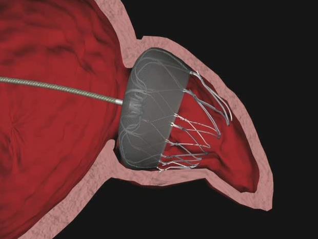 WATCHMAN LAA Closure Device for Stroke Prophylaxis and Atrial
