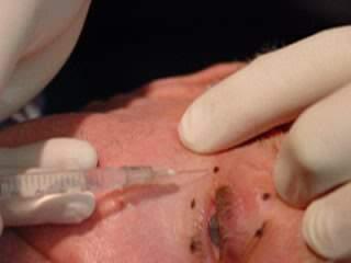 Intramuscular Injection Botox administered Subcutaneously Injection directly in the