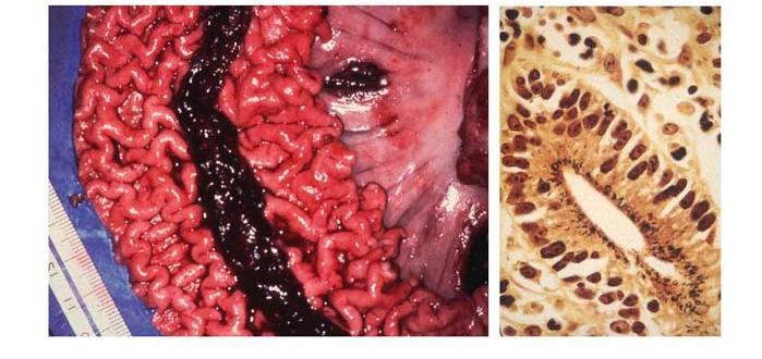 ileitis Adenomatous proliferation of immature enterocytes thickens the intestinal mucosa