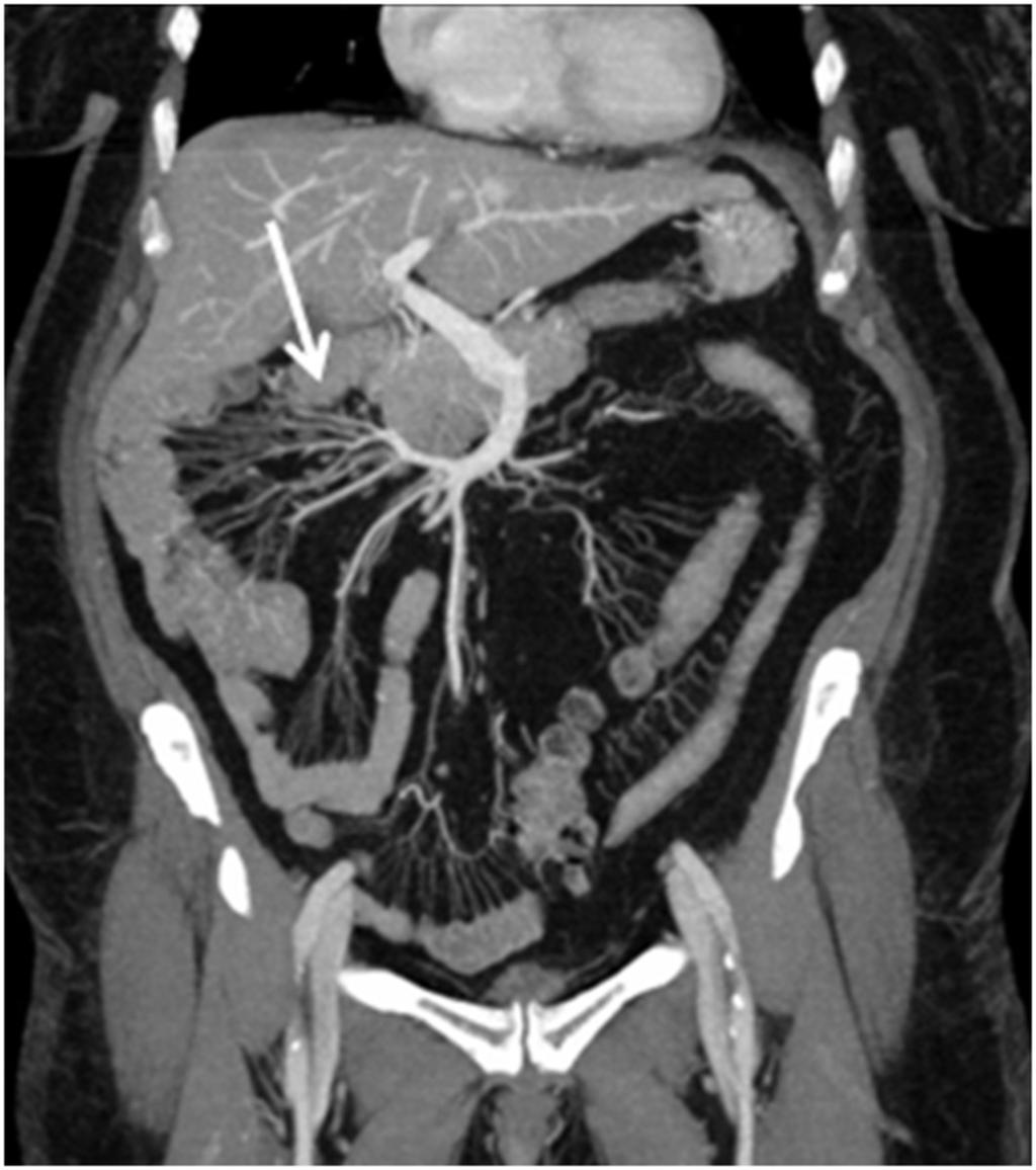 Fig. 6: Coronal plane (MIP). CT scans show a rightward course of the proximal jejuna branches.