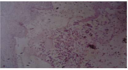 Figure 4 Microscopic photo of a case of abdominal cystic lymphangioma showing lymphatic spaces lined by flattened endothelial cells, lymphocyte aggregates in stroma and remnants of smooth muscle