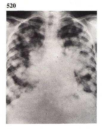 3- Chest X-RAY, because the pulmonary metastasis is very common in Wilm's tumor. Early metastasis will show what we call canon balls appearance (not sure about spelling) with no pulmonary symtoms.