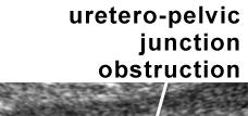 Uteropelvic junction obstruction: 44-65% the