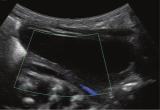 (arrow); (c) right parasagittal image, bladder: mild dilatation of the right