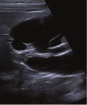image shows increased renal parenchymal echogenicity of the crossed fused left
