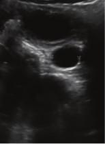 image shows moderate dilatation of the proximal left ureter to the right of