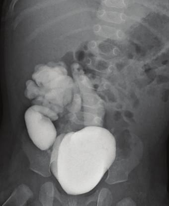 Figure 2: VCUG, 6 months of age: dilated atretic right ureter with high grade