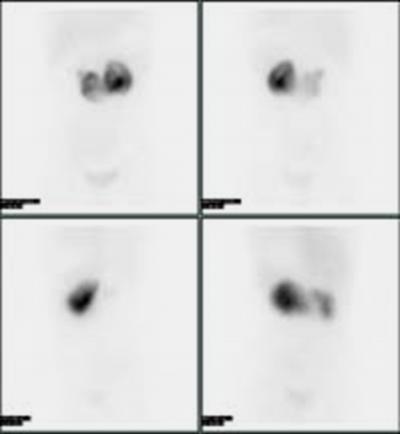 with urinary tract infection. Tc99m DMSA renal cortical scintigraphy demonstrated a Horseshoe kidney associated with pyelonephritis and scarring (Fig. 2).