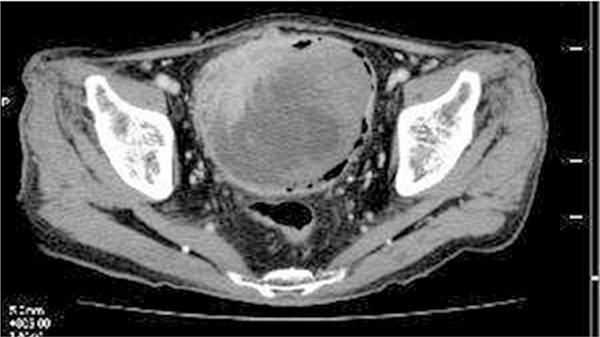 Figure 1. Computed tomography shows an irregularshaped tumor involving the entire layer of the urinary bladder in the right anterior wall.