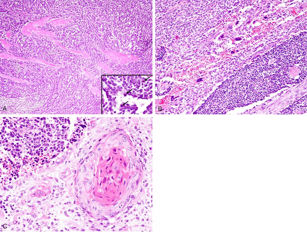 Figure 2. Histopathological features of the urinary bladder tumor. A: Proliferation of small round cells invading into the muscular layer of the urinary bladder.