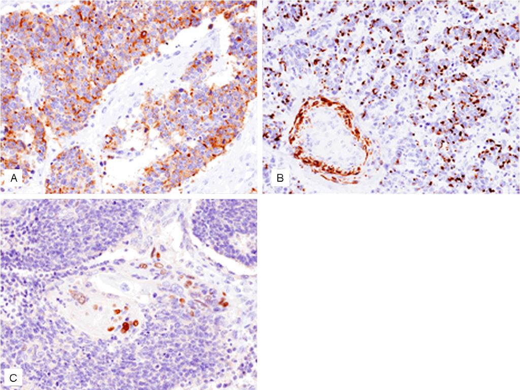 Figure 3. Immunohistochemical features of the urinary bladder tumor. A: Synaptophysin is expressed in the small round cells, x200. B: p63 is expressed in the squamous cell carcinoma, x200.