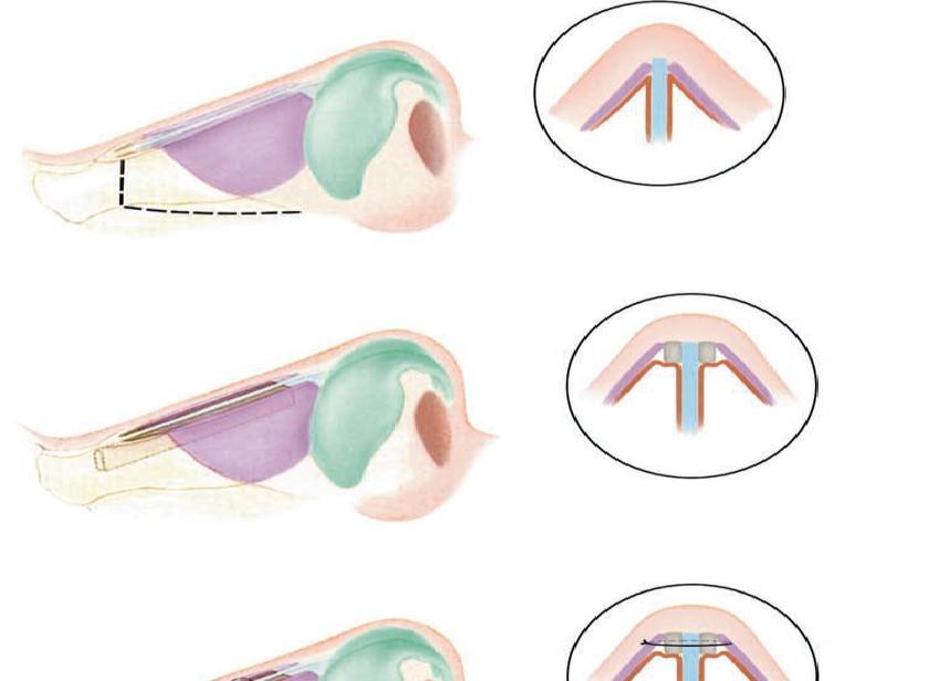 functional rhinoplasty and used when there is collapse at the sidewall.