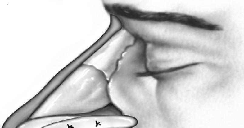(15) Alar batten grafts can be applied via the endonasal or external rhinoplasty approach.