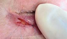 Both methods advocate the placement of three stitches: one in the middle and one each 0 mm to the left and right of that.