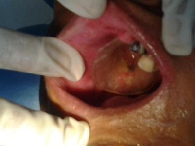 It is then fitted to a palatal plate.
