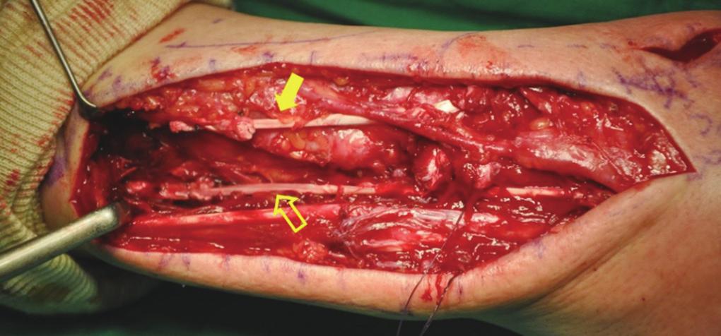 After removing the bony protrusion, the surrounding soft tissue was pulled to the ulnar side and sutured to the remaining tendon sheath and periosteum of the 3rd compartment to prevent further tendon