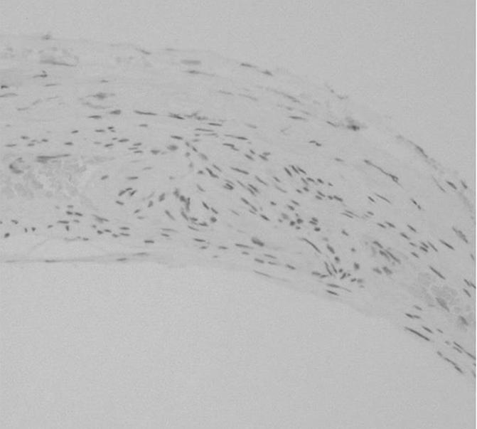 031 Scattered pattern Negative pattern Aggregated pattern 0 10 20 30 40 50 60 Months Figure 2 Five-year recurrence rates for the negative staining pattern, the scattered pattern, and the aggregated