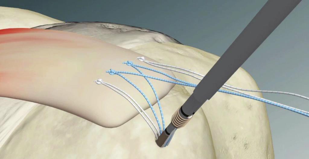 4 Holding the free ends of the sutures, advance the loaded implant percutaneously or
