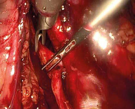 Laparoscopic nephroureterectomy with transvesical single-port distal ureter and bladder cuff dissection: