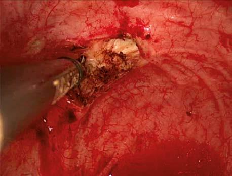 A Circuitous dissection of the ureteral orifice and bladder cuff with a hook electrode.