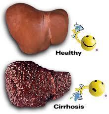 DISEASES CAUSED DUE TO FUNGI Cirrhosis: It occurs due to Aflotoxin, produced by Aspergillus spp.