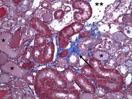 Balkan Endemic Nephropathy: It is a kind of urinary tract tumors caused by Ochratoxin A (OTA).