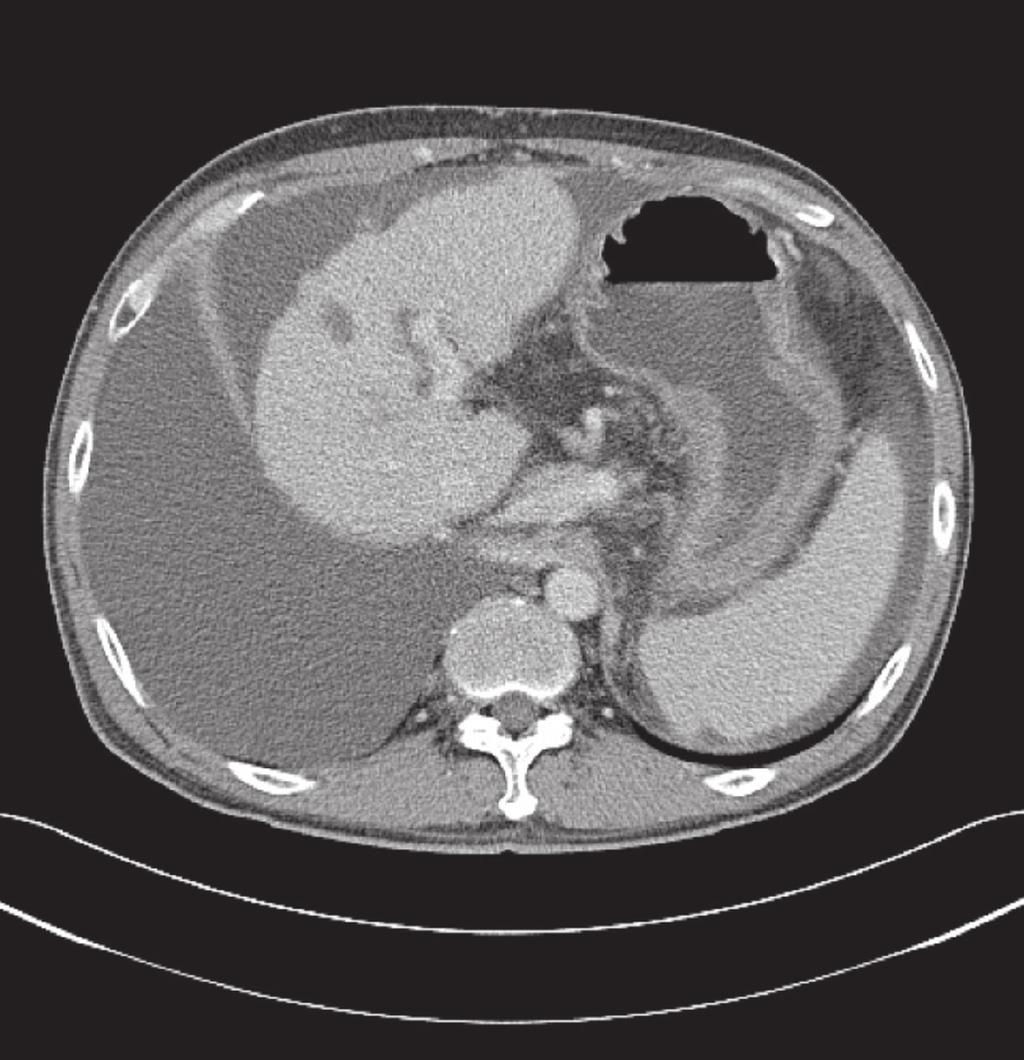 Goong HJ, et al. Remission of Refractory Hepatic Hydrothorax A B Fig. 2.