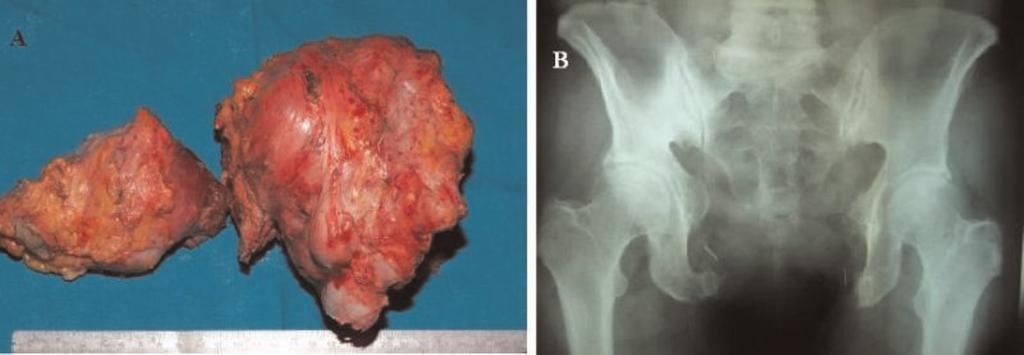 Figure 4. The removed chondrosarcoma (A) and a two-year-postoperative radiograph (B).