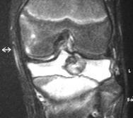 Chondroblastoma  