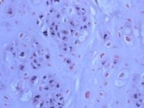 CHONDROSARCOMA- Histology Grade Cytology Matrix I (50-60%) Similar to enchondroma slightly increased cellularity Chondroid Rare, focal necrosis II