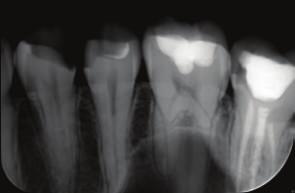 2 Case Reports in Dentistry 3. Discussion Figure 1: Initial radiography showing proximal cavity on tooth number 27.
