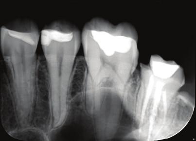 Case Reports in Dentistry 3 (a) (b) Figure 3: (a) and (b) Periapical and panoramic films show no evidence of lesion in the upper