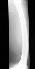 Lateral view of left femur X-ray show lateral and anterior bowing deformity of left femur in contrast to frequent lateral bowing deformity of Pagetic femur.