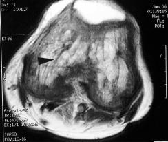 loss of cartilaginous inner calcified zone, resulting in thinning and irregularity of remaining cartilage.