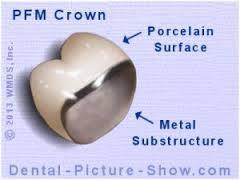 crown as shells and veneer covers to give the