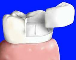 tooth cusps and side wall area that is